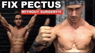 NEW FIX PECTUS CHALLENGE (DON'T MISS OUT!)