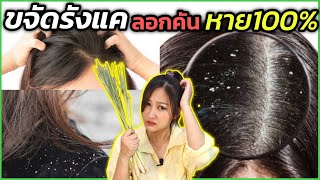 รังแคเต็มหัว เชื้อรา คันหนังศีรษะ!! รีบใช้สูตรนี้ ไร้สารเคมีด้วยสมุนไพรไทย หายจริง100% l สรรหามาทำ