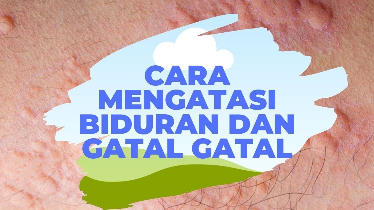 Cara Mengatasi Biduran & Gatal-gatal - YouTube