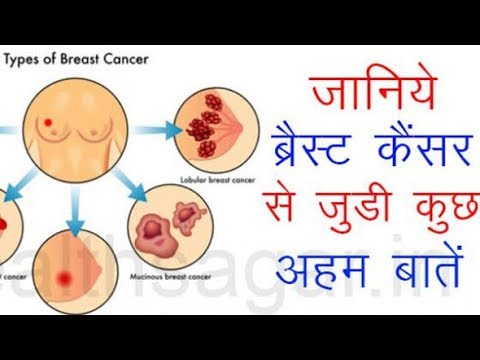 Breast Cancer - Symptoms and Treatment In Hindi Breast Cancer - Symptoms and Treatment In Hindi