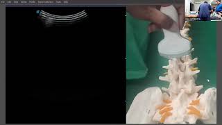 Ultrasonography of Lumbar Spine