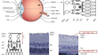 Retinal implant | Wikipedia audio article