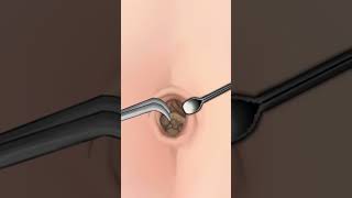 ASMR |  Navel Stone  Belly Button Ring Remove Animation