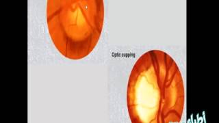 Practical Ophthalmology - Glaucoma \u0026 Lacrimal Slides