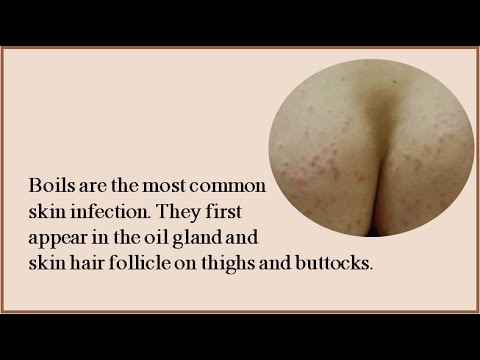 Get Rid Of Boils On Inner Thighs And Buttocks fast and natural Get Rid Of Boils On Inner Thighs And Buttocks fast and natural