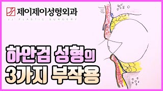 하안검 성형의 3가지 부작용