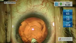 IC-8 Apthera Lens Surgery