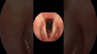 Vocal Cord Polyp Formation and Resolution Time Lapse