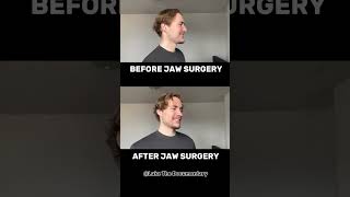 Before After Double Jaw Surgery