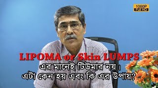 LIPOMA/Skin Lumps মানেই টিউমার নয়! এটা কেন হয় এবং উপায় কি? | Dr Debabrata Bose | EP 477