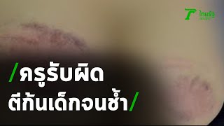 ครูตีเด็กก้นช้ำรับผิด ไม่ใช้ไม้เรียวตลอดชีวิต | 03-02-64 | ข่าวเที่ยงไทยรัฐ