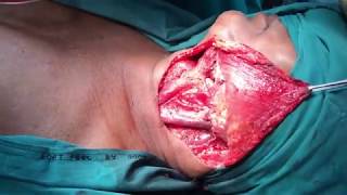 Mouth or Oral Cancer Surgery Cure | Neck Dissection