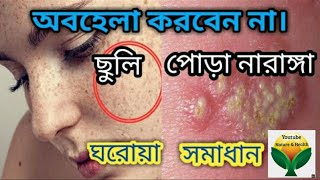 ছুলি ও পোড়া নারাঙ্গা রোগের খুব সহজ সমাধান।ছুলি ভালো করার সহজ উপায় ।urticaria or herpes treatment.