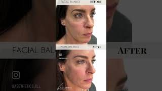 Facial Balancing #botox #beauty #filler