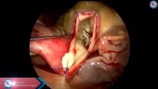 Totally endoscopic aortic valve replacement (TEAVR)