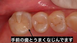 歯科治療を解説［ノンメタル治療その３］白い歯の詰め物の治療です。手前の歯となじませるため、溝を黒くしています。（今回は）eMax 2ケイ酸リチウムによる治療です