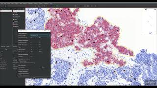 Using Qu Path Ki-67 estimation in NET