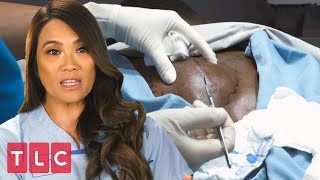 A Dangerous Lump Near the Spine | Dr. Pimple Popper