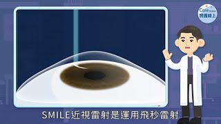 單眼雷射10秒鐘，隔天正常生活，Smile Pro全飛秒近視雷射手術再進化