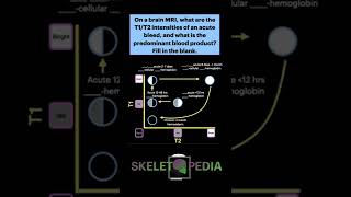 How to identify BRAIN BLEED acuity on MRI in 30 seconds #Shorts #Radiology #Brain