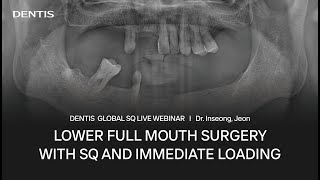 DENTIS GLOBAL SQ LIVE WEBINARㅣ DENTIS