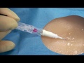 Arrow® Arterial QuickFlash