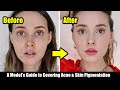 How I Cover My Acne, Acne Scars, & Skin Pigmentation | A Model's Tips *Easy, Non-Cakey*