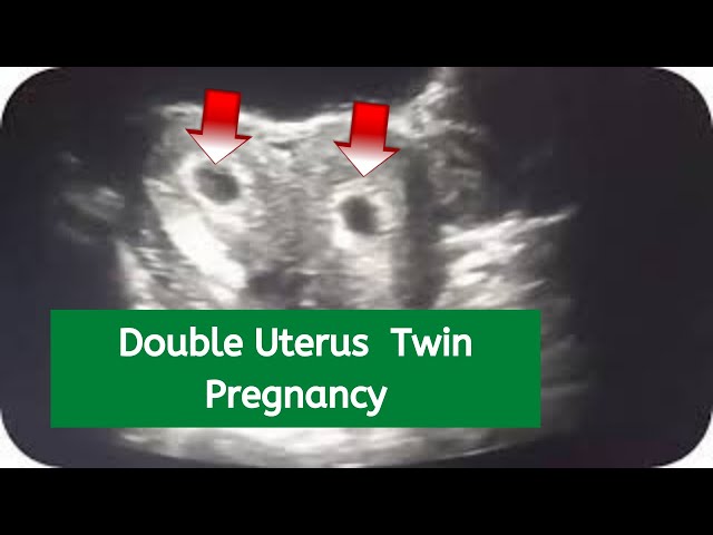 Twin Pregnancy In Uterus Twin Fetuses Associated With Double Amniotic
