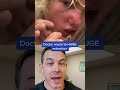 giant pimple extraction on nose 208skindoc