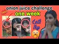 let's test onion juice on hair for one week|cured baldness|How to use Onion for hair growth|tamil