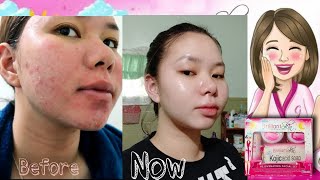 15 Days Using BRILLIANT SKIN ESSENTIAL ✅+ REJUVENATING SET REVIEW