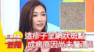 這疹子呈網狀斑點、膿泡，成病原因尚未釐清？！【#醫師好辣】20201203 part2 EP1061 洪素卿 陳保仁