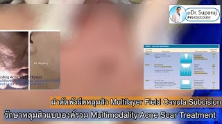 รักษาหลุมสิวแบบองค์รวม Multimodality Acne Scar Treatment: Picosecond Laser Subcision l หมอรุจชวนคุย