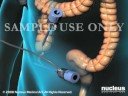 laparoscopic appendectomy surgery for appendicitis 2008