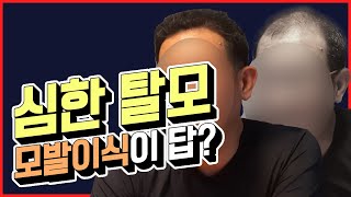 모발이식닥터 Q\u0026A 08. 심한 남성형 탈모도 모발이식으로 개선이 가능할까요? (feat. 비절개 모발이식 3000모 후기)