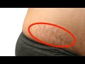 🛑 maxaa sababa haarahaaan jirkaadana maku aragtay stretch marks