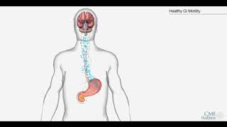 Narrated Diabetic Gastroparesis 3 D Animation