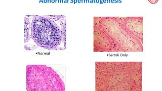 Grand Rounds- Male Infertility