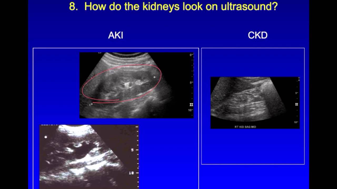 Damaged Kidney Ultrasound