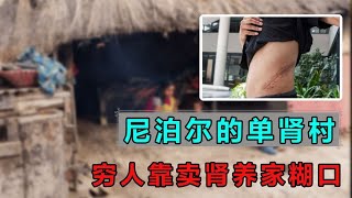 尼泊爾的單腎村，窮人靠賣腎養家糊口，人人身上都有一道疤！