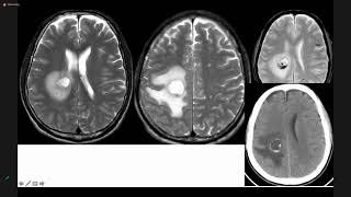 MRI U NÃO DI CĂN | BS. Phạm Hữu Khuyên