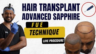 Hair transplant in Mumbai | Advanced Sapphire FUE Technique (Live Procedure) | CARA Hair Transplant