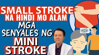 Small Stroke na Hindi Mo Alam. Mga Senyales ng Mini-Stroke. - By Doc Willie Ong