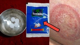 दाद खाज खुजली को 5 मिनट में ऐसे गायब करें,जानिए कैसे | daad,khaj,khujli,faster remove treatment tip