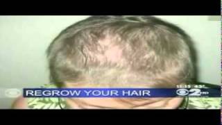 iGrow Laser NY CBS News feature by Evolution Hair Loss Institute