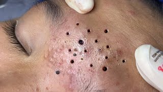 Big Cystic Acne Blackheads Extraction Blackheads \u0026 Milia, Whiteheads Removal Pimple Popping # 1255