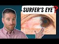 Surfer's Eye - Penjelasan Pterigium (Pertumbuhan Pada Mata Anda)