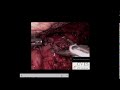 laparoscopic gastroduodenostomy after esophagectomy for impaired gastric emptying