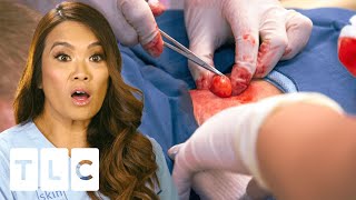 Dr. Lee Helps Patient With Hundreds Of Tumours! | Dr. Pimple Popper | UNCENSORED | 18+
