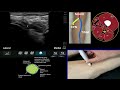 msk ultrasound evaluation of the bifurcation of the sciatic nerve at the posterior knee